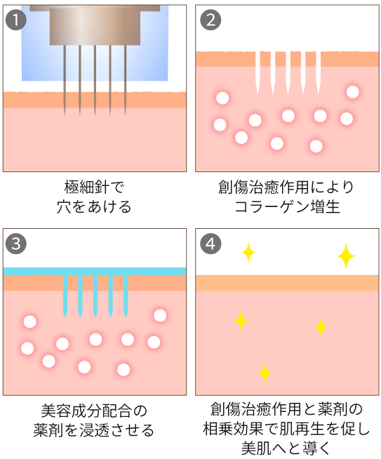 ダーマペン４