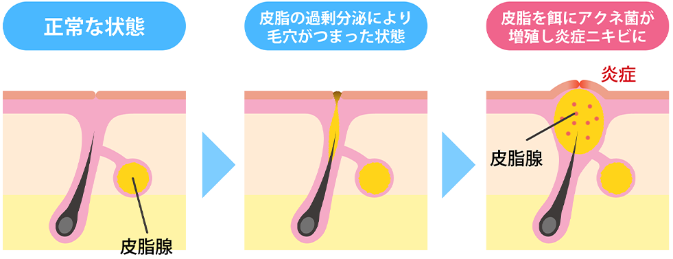 正常な状態、皮脂の過剰分泌により毛穴が詰まった状態、皮脂を餌にアクネ菌が増殖し炎症ニキビに