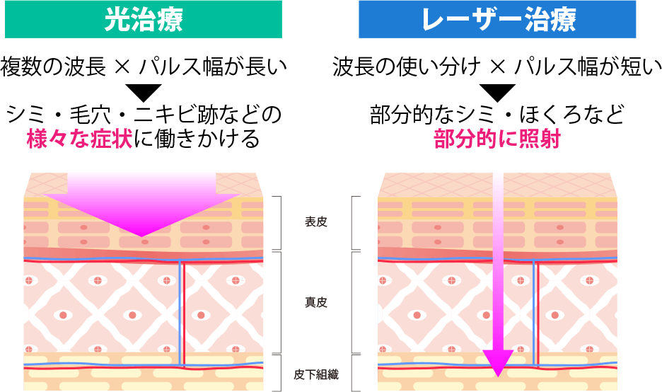 光治療 複数の波長×パルス幅が長い→シミ・毛穴・ニキビ跡などの様々な症状に働きかける。 レーザー治療 波長の使い分け×パルス幅が短い→部分的なシミ・ほくろなど部分的に照射