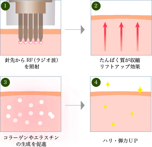 真皮層に届く熱エネルギー