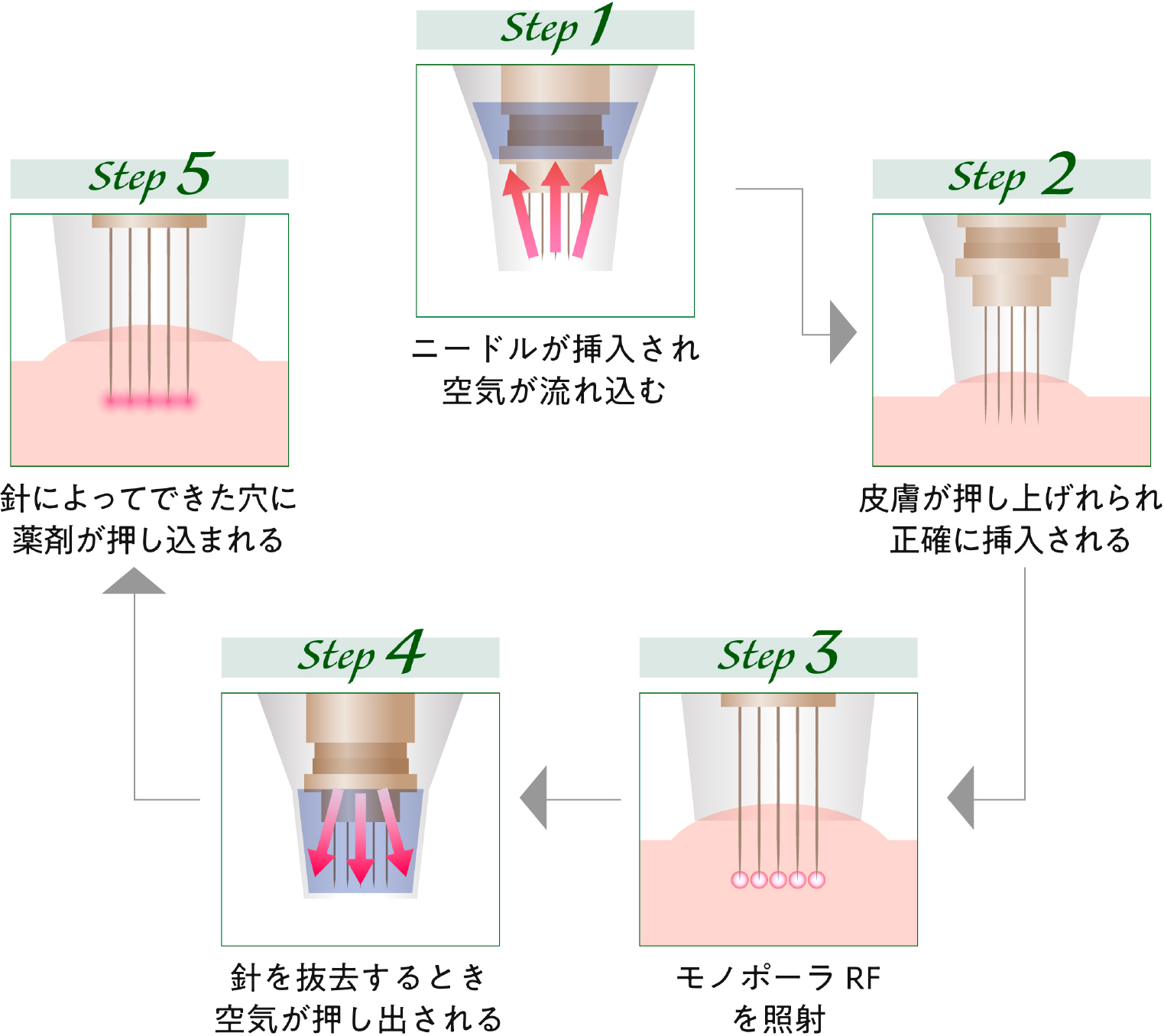 薬剤を正確に注入するドラッグデリバリーシステム