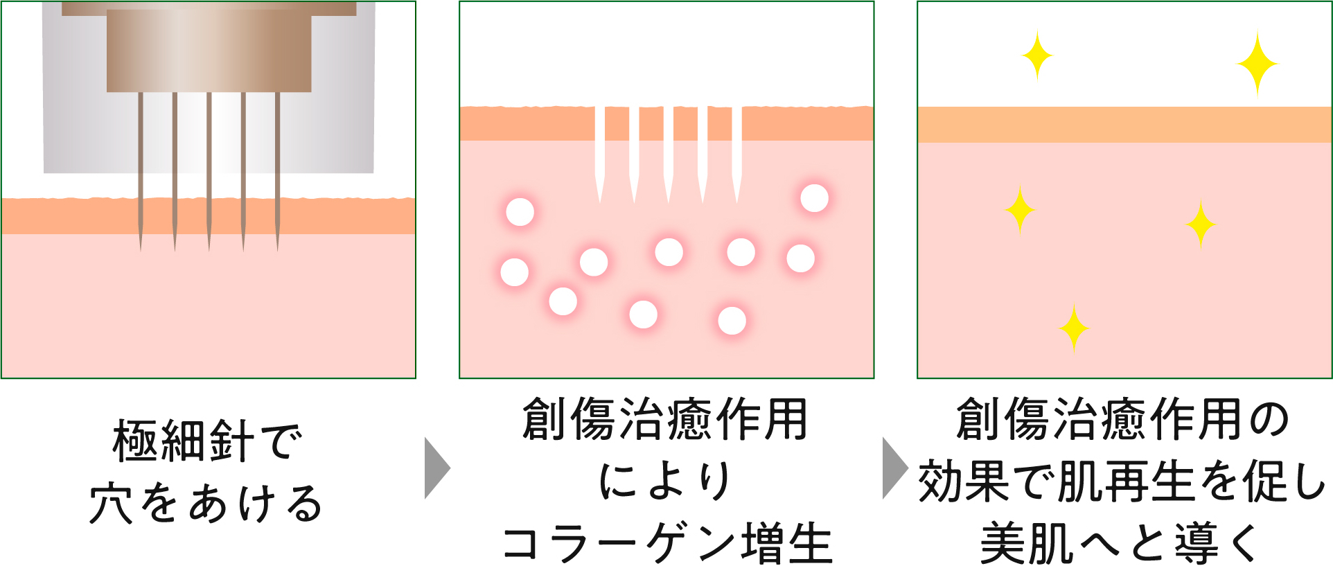 微細なニードルでターンオーバーを促進