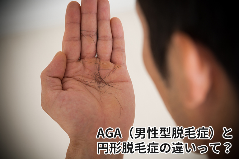 AGA（男性型脱毛症）と円形脱毛症の違いって？