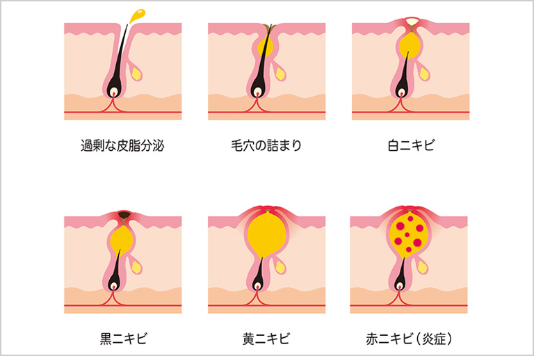 ニキビ