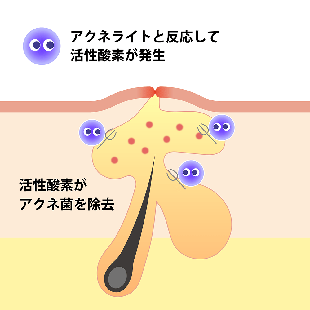 アクネライトの効果