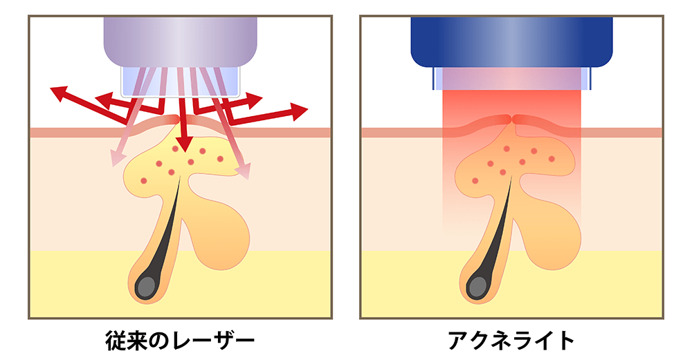 アクネライトのメリット