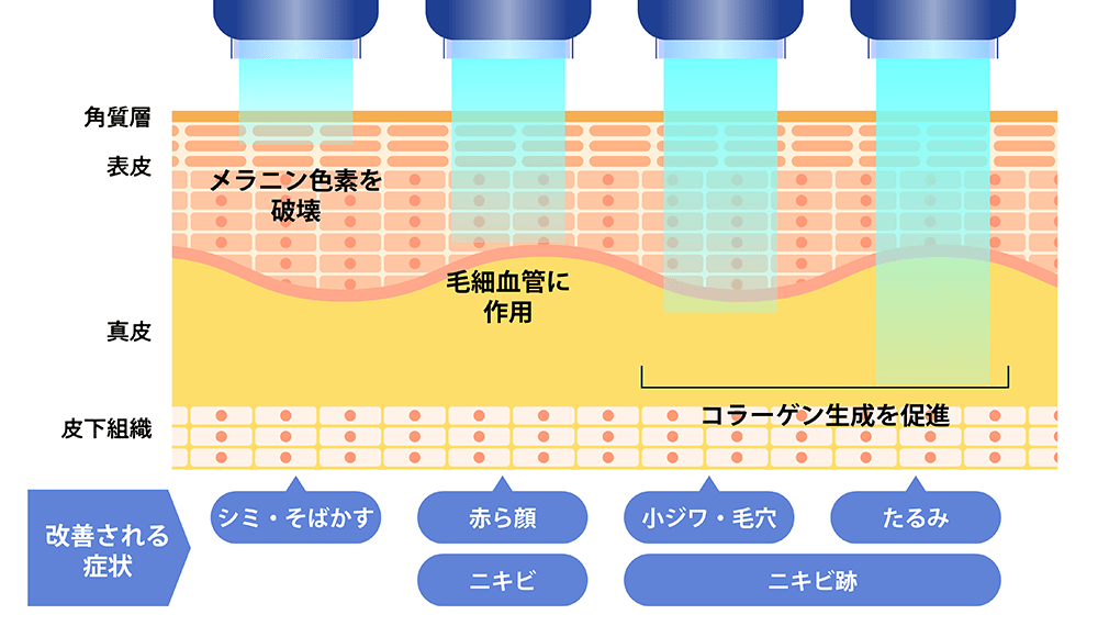 アクネライト