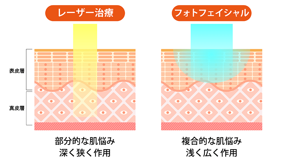 フォトフェイシャルとレーザー治療の違い