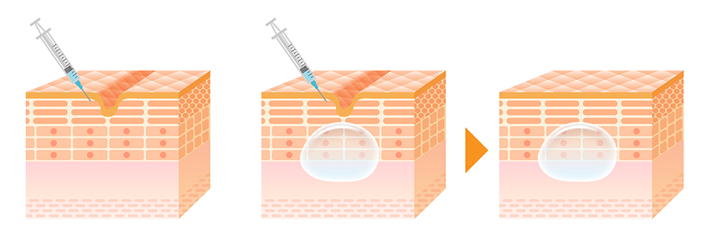 ヒアルロン酸注入治療
