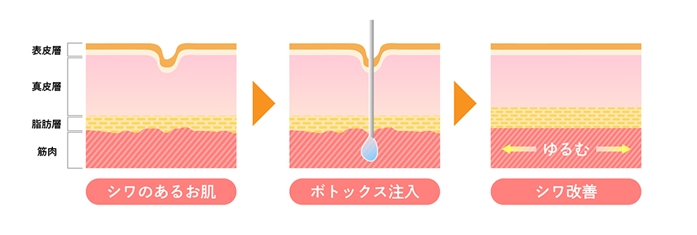 ボトックス注入治療