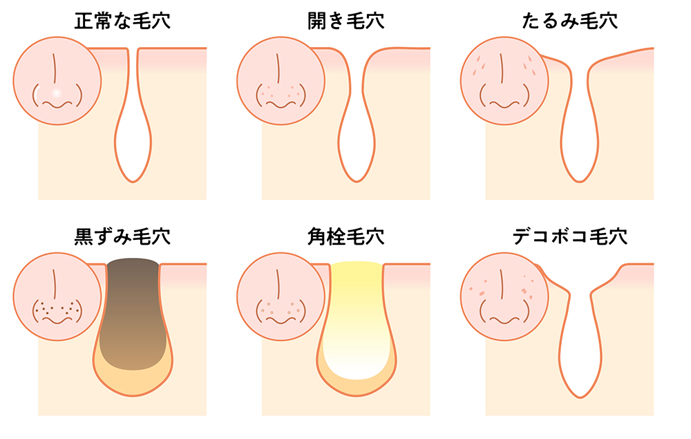 毛穴の種類