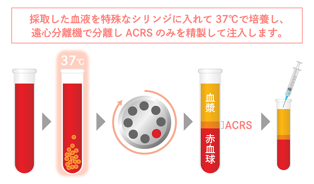 ACRSのメリット