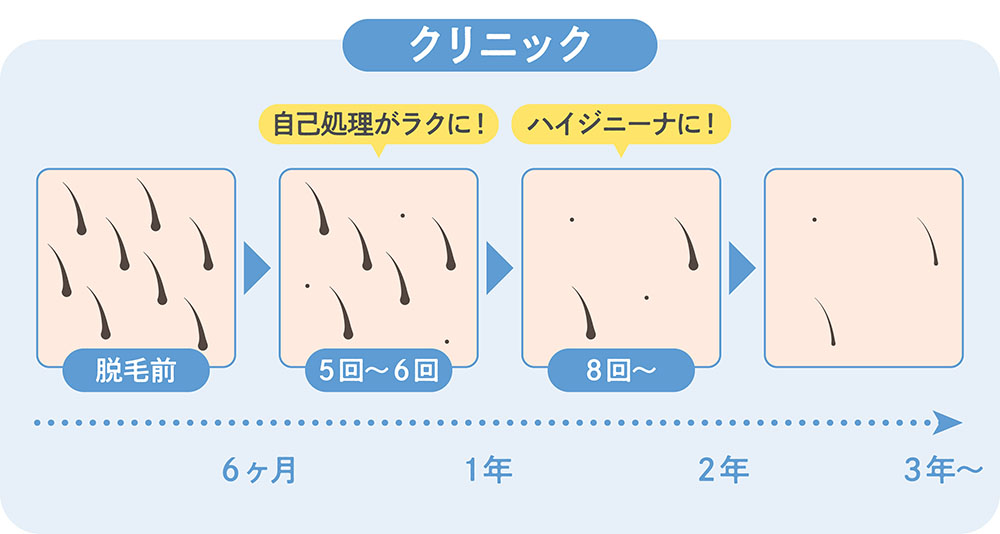 クリニックでの医療脱毛