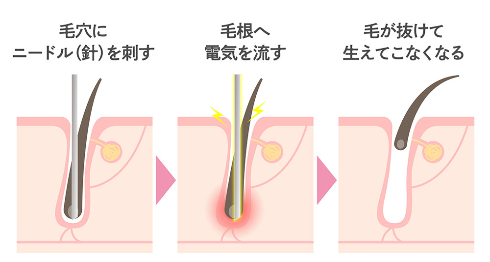 ニードル脱毛