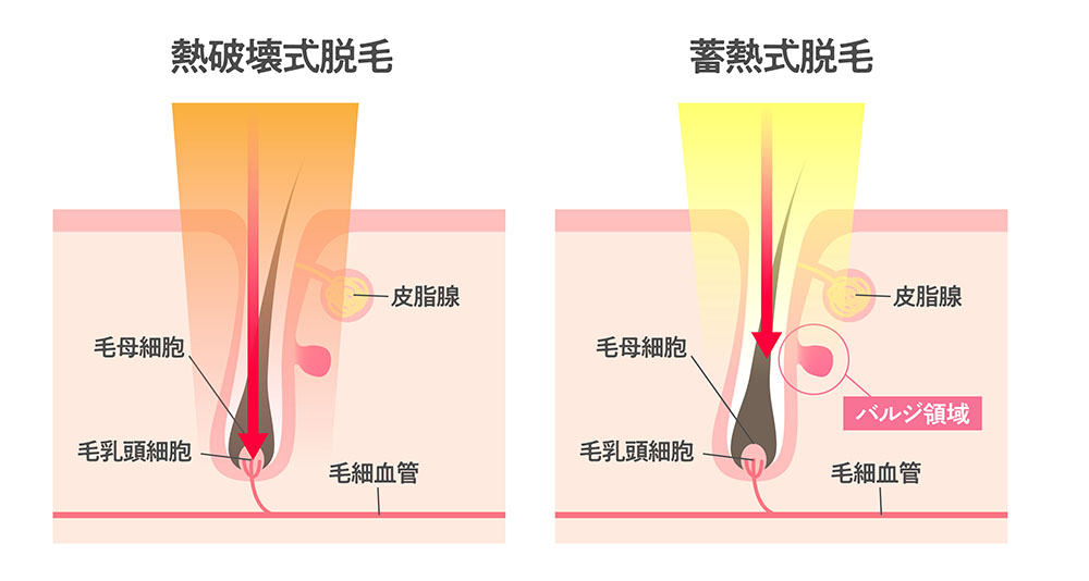 痛みの少ない脱毛器を選ぶ