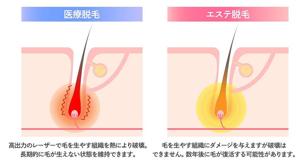 医療脱毛とサロン脱毛の比較