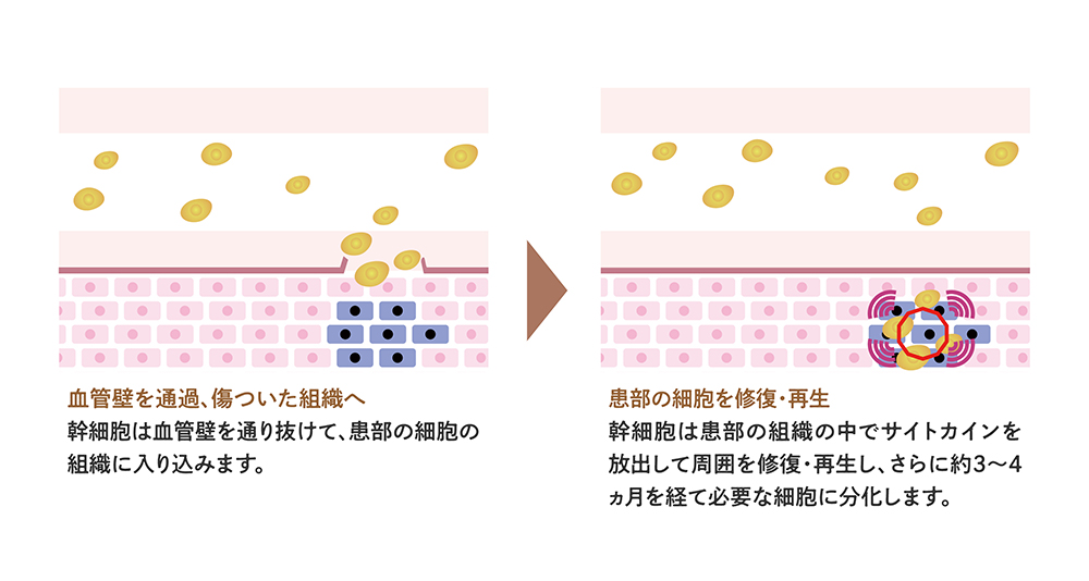 幹細胞治療