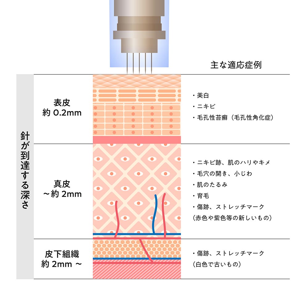 針の深さを調整できるから幅広い肌悩みに対応