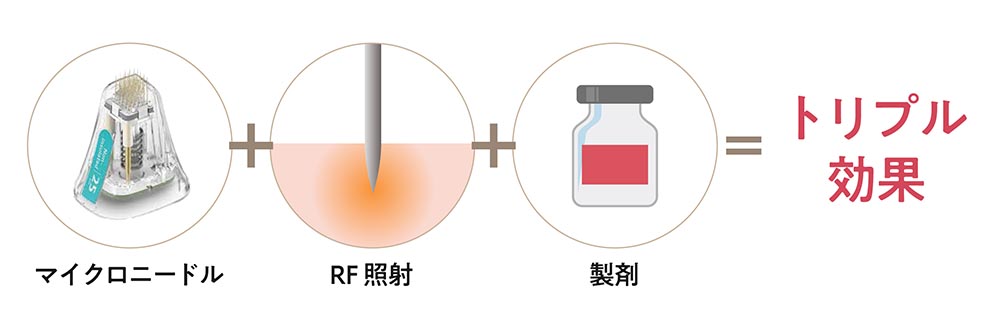 ポテンツァは痛みやダウンタイムが少ない最新美肌治療法