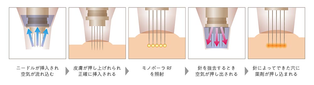 ポテンツァの仕組み