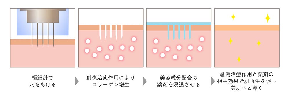 超極細針で肌の再生を促すエイジングケア治療