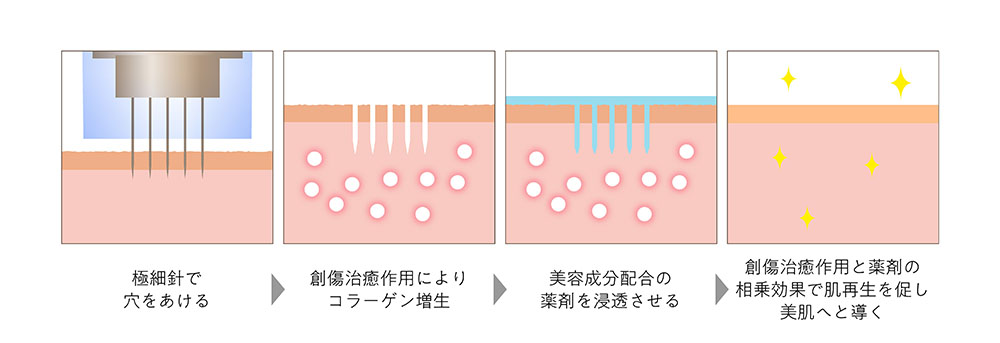 ダーマペンのメカニズム