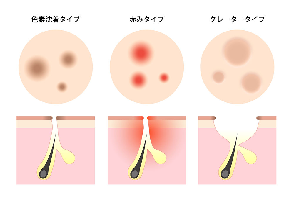 ニキビ跡には「赤み」「色素沈着」「クレーター」の3つのタイプがある