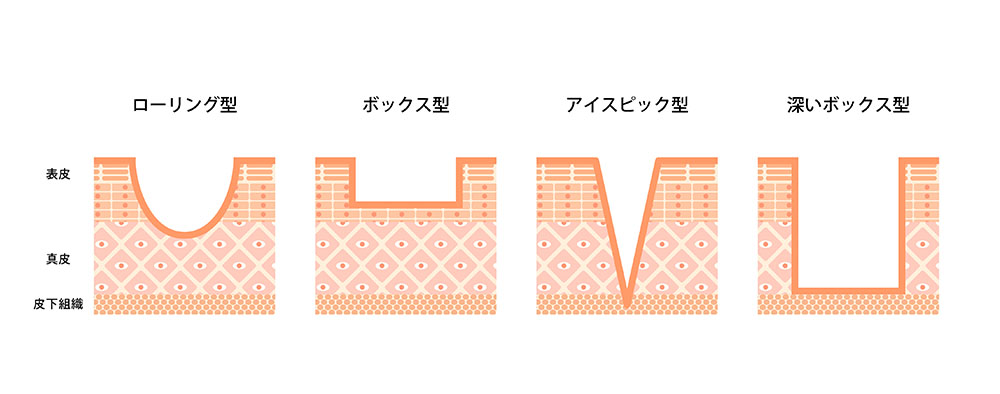 クレーターは深さや凹み方で3つのタイプに分けられる