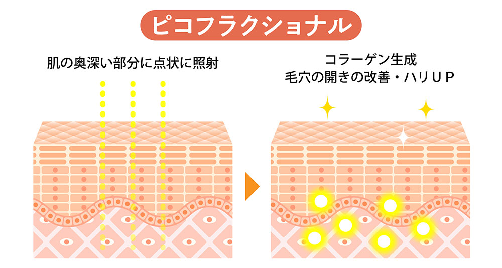 ピコフラクショナル