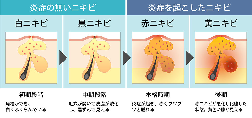 ニキビができたら皮膚科にいくべき？