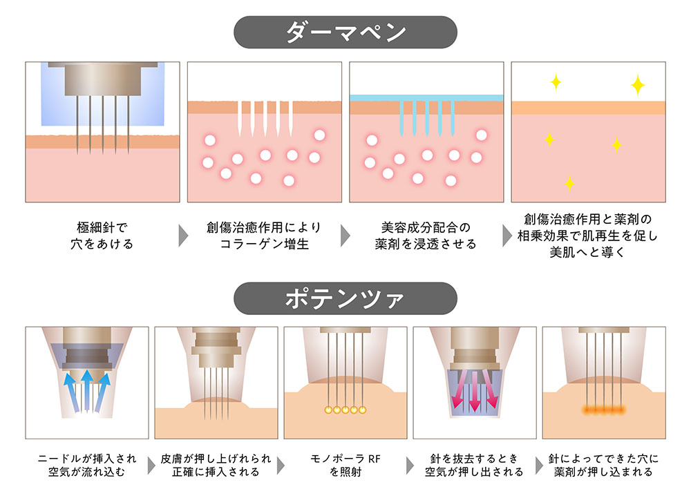 ダーマペンとポテンツァの比較