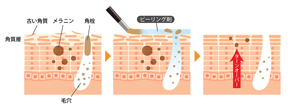 ケミカルピーリング