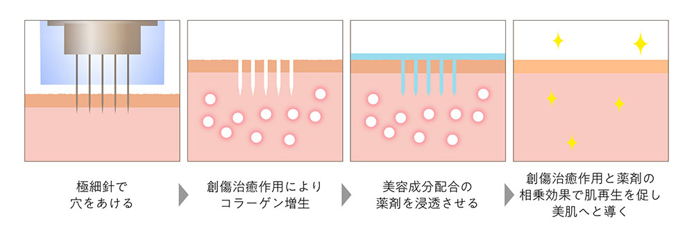 ダーマペン