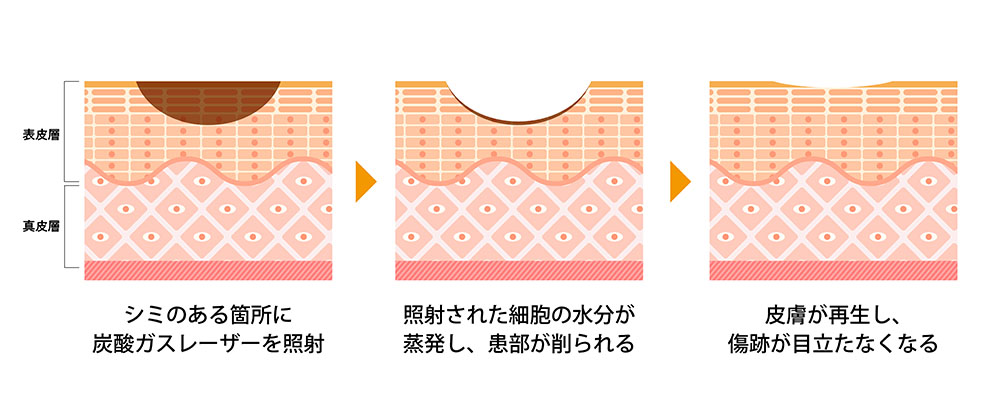 炭酸ガスレーザー