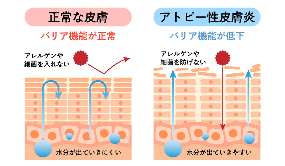 タクロリムス軟膏が作用するメカニズム