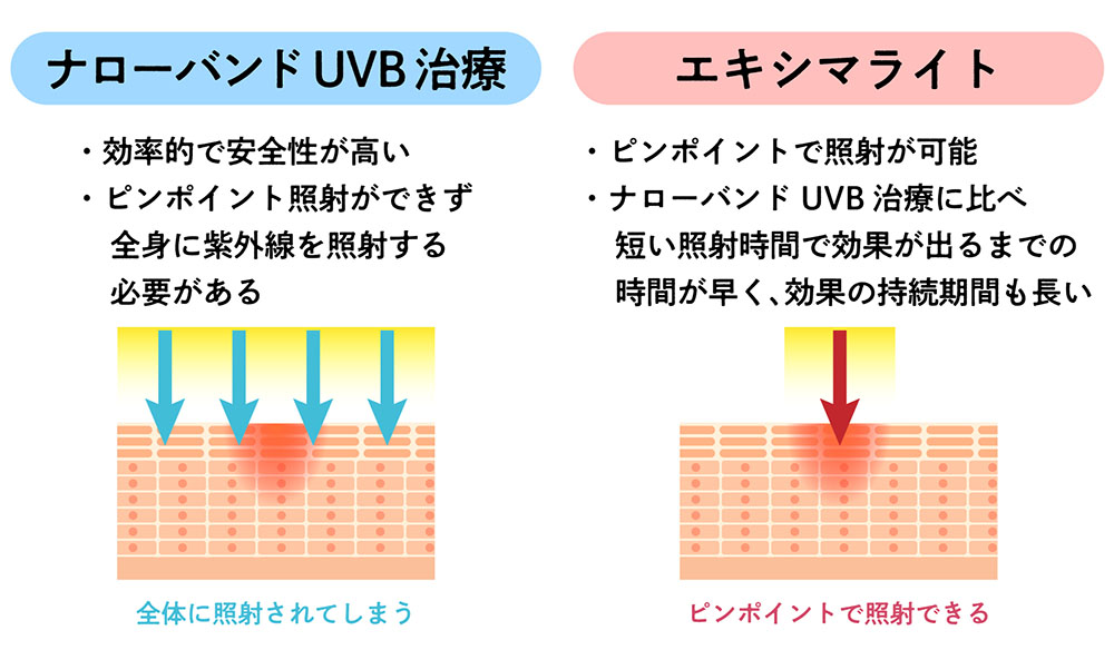 ナローバンドUVBとエキシマライト