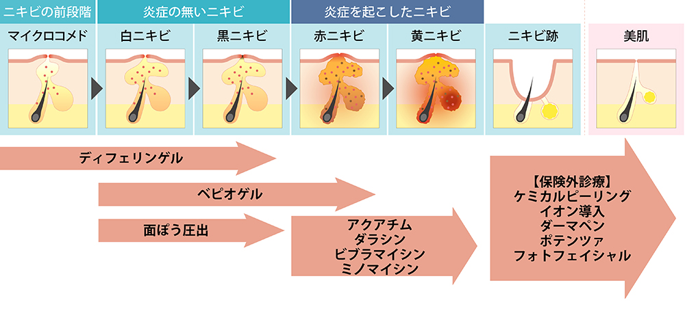 当院でのニキビ治療法一覧