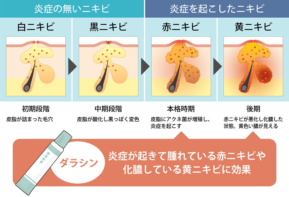 ビブラマイシンが効くニキビと効かないニキビ