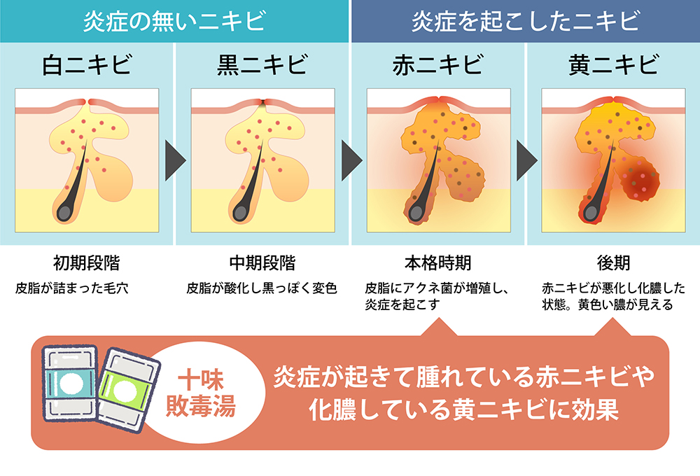 十味敗毒湯はどんなニキビに効く？効果が出る時期は？