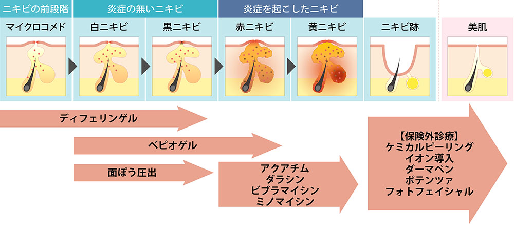 ニキビ治療一覧