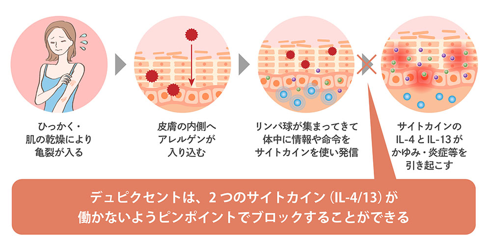 デュピクセントの効果と作用する仕組み