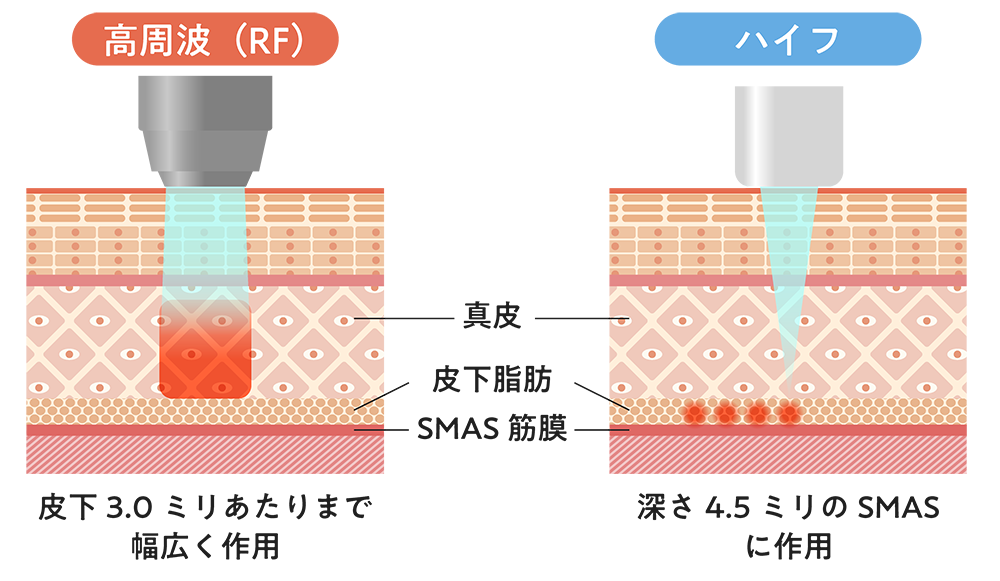 高周波（RF）とハイフの違い