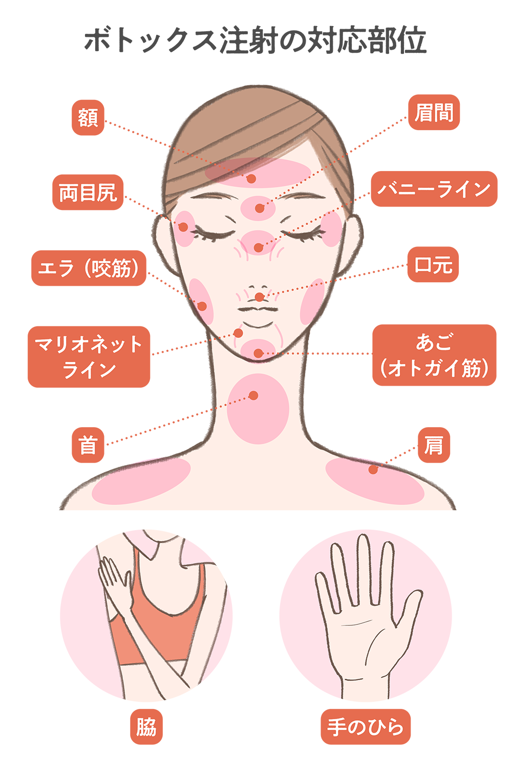こボトックス注射の対応部位と効果