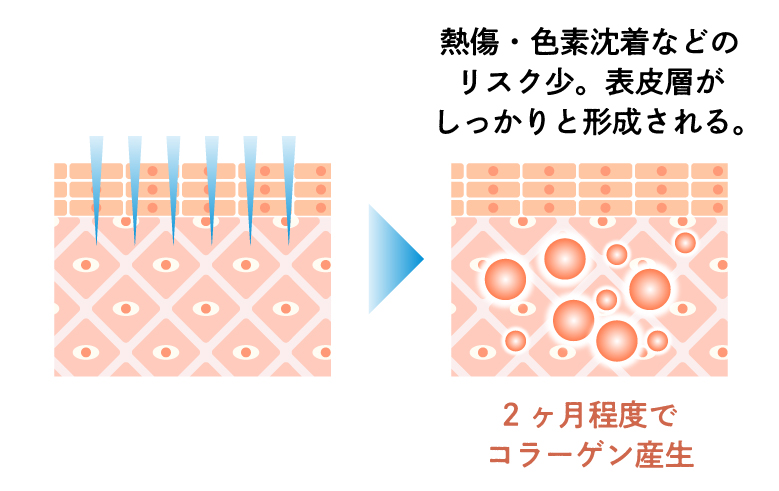 ダーマペンの特徴