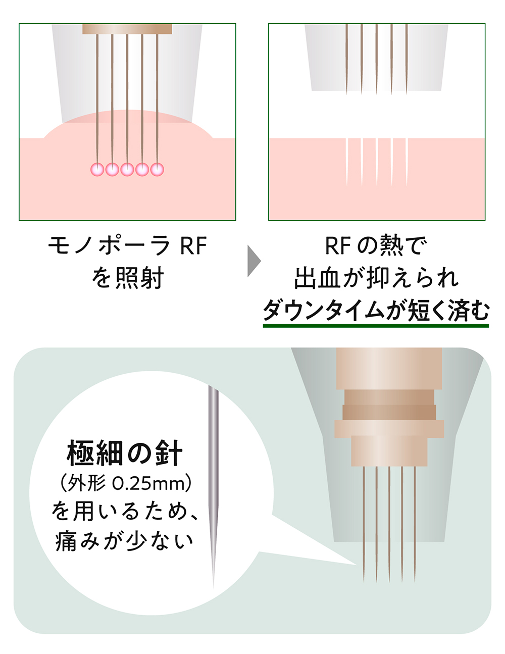 ピコフラクショナルの特徴