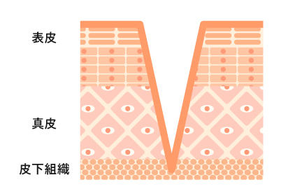 アイスピックタイプタイプイメージ図